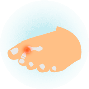 Молоткообразные пальцы