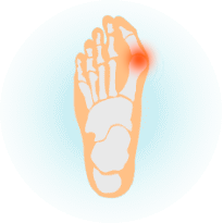 Вальгус пальца стопы