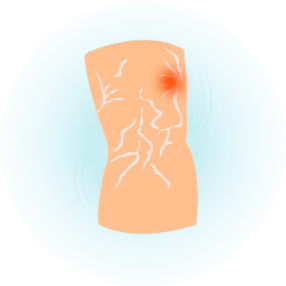 Варикоз и отёки